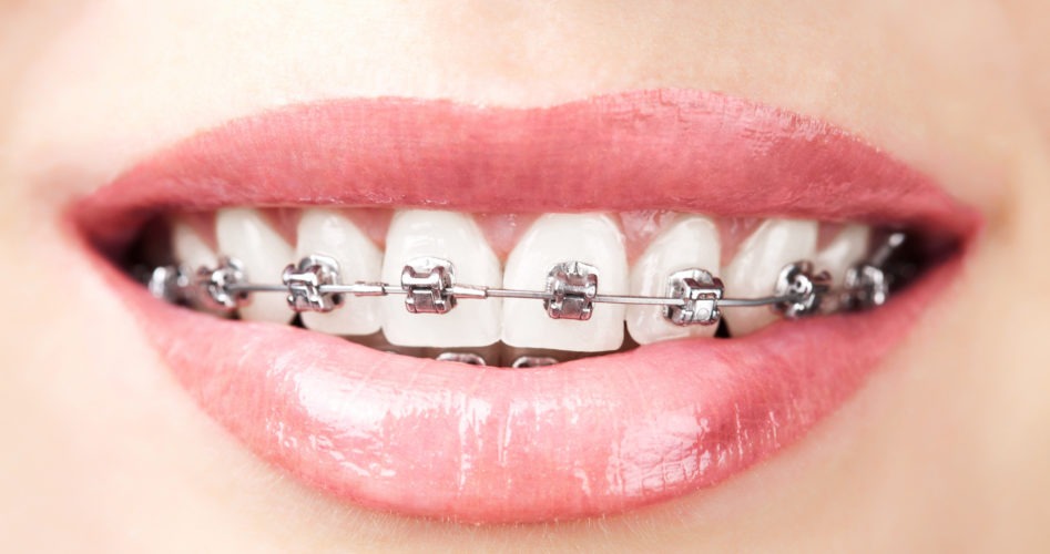 10 Reasons You Should Consider Getting Braces