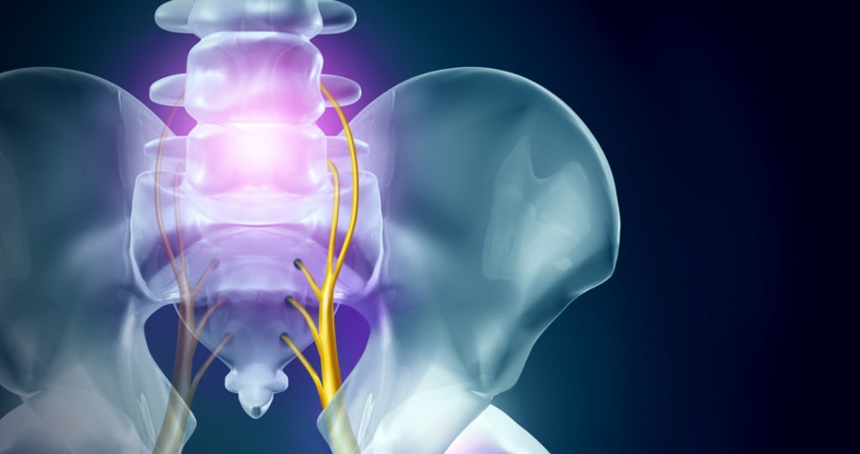 Could Sciatica Be the Cause of Your Back Pain? Here's